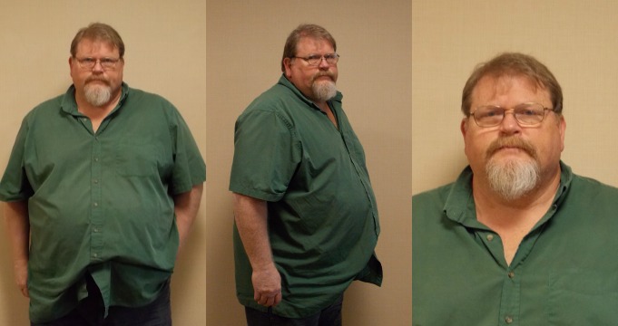 Dr. Keith McEwen MD Indianapolis Indiana Carmel Nobelsville Anderson Hamilton Community Surgery Center Hamilton Community Bariatrics Hamilton 46060 46011 46062 46033 46037 46074 46032 46220 46226 46055 46064 46030 46203 46239 46259 46163 46142 46143 lap-band system lap band system cost lap band system reviews lap band system patient education seminars lap band system access port lap band system pedometer lap band public system lap band ap system mri safety bioenterics lap band system lap-band ap system small lap band system lap-band system allergan lap band ap system large lap band gastric banding system franciscan health system lap band the new lap band system lap band through public system lap band surgery public system lap band system surgery the lap band system lap-band vg system what is lap band systemlap-band procedure lap-band removal lap-band system lap-band cost lap-band weight loss surgery lap-band complications lap-band diet lap-band® lap-band reviews lap-band alternative lap-band lap-band surgery lap-band adjustable gastric banding system lap band and pregnancy lap band australia lap band after gastric bypass lap band az lap band adjustment lap band and alcohol lap band and acid reflux lap band austin a lap band surgery a lap band removing a lap band can lapband be removed is a lap band permanent is a lap band safe is a lap band covered by insurance is a lap band reversible how a lap band works does a lap band work lap band before and after lap band before and after pictures lap band blog lap band before and after pics lap band brisbane lap band bmi lap band birmingham al lap band blockage lap band before and after stories lap band bariatric surgery b-2240 lap band lap band cost without insurance lap band covered by insurance lap band criteria lap band complications years later lap band canada lap band chicago lap band calgary lap band cons realize c lap band clap clap band clap clap bandcamp c section with lap band c-section and lap band surgery c section after lap band hepatitis c and lap band surgery lap band diet menu lap band diet plan lap band dallas lap band diet recipes lap band doctors lap band diet after surgery lap band dance lap band deaths lap band diet without surgery vitamin d deficiency lap band lap band erosion lap band edmonton lap band eligibility lap band erosion causes lap band eating plan lap band erosion lawsuit lap band experiences lap band eating rules lap band esophagus problems lap band erosion complications o que e lap band lap band forum lap band fill lap band failure lap band friendly recipes lap band forum australia lap band failure rate lap band food stuck lap band fill centers lap band failure stories lap band fort worth lap band gal lap band gone wrong lap band gas pain lap band gaining weight back lap band guidelines lap band gurgling noises lap band green zone lap band gallbladder issues lap band good or bad lap band gerd issues lap band houston lap band hypnosis lap band horror stories lap band heartburn and reflux lap band heartburn lap band hypnotherapy lap band houston cost lap band hobart lap band hair loss lap band hernia h pylori lap band lap band insurance lap band issues lap band in mexico lap band information lap band images lap band indiana lap band insurance requirements lap band infection lap band in houston lap band in mexico cost i lap band i want lap band surgery lap band jacksonville fl lap band journey lap band journey blog lap band jackson ms lap band joplin mo lap band joondalup lap band journal lap band jonesboro arkansas lap band jokes lap band juicing j&j lap band lap band kansas city lap band kaiser lap band knoxville tn lap band kelowna lap band killeen texas lap band katy tx lap band kidney stones lap band korea lap band kingsport tn lap band katy lap band lawsuit lap band las vegas lap band liquid diet lap band louisville ky lap band little rock ar lap band leak symptoms lap band lubbock lap band liquid diet recipes lap band long term complications lap band los angeles lap band mexico lap band meal plan lap band miami lap band mri safety lap band melbourne lap band meals lap band macon ga lap band medicare lap band memphis lap band mexico cost u of m lap band surgery lap band not working lap band not losing weight lap band night cough lap band nj lap band nz lap band nyc lap band no surgery lap band no weight loss lap band nausea lap band nutrition guidelines lite n easy lap band lap band or sleeve lap band okc lap band of louisville lap band ontario lap band orlando lap band operation lap band oklahoma lap band ontario cost lap band omaha lap band or sleeve which is better o sign lap band o'brien lap band placer cost of lap band surgery symptoms of lap band erosion removal of lap band dangers of lap band surgery symptoms of lap band slippage complications of lap band surgery complications of lap band cost of lap band removal lap band problems lap band pictures lap band pros and cons lap band pre op diet lap band port lap band price lap band port pain lap band post op diet lap band pregnancy s p lap band lap band qualifications lap band qualifications 2014 lap band qualifications 2015 lap band qualifications 2013 lap band questions lap band questions and answers lap band quiz lap band queensland lap band quick weight loss lap band qld q&a lap band lap band requirements lap band recipes lap band recovery lap band risks lap band results lap band removal recovery lap band removal surgery lap band removal complications lap-band surgery pros and cons lap band surgery cost lap band side effects lap band slippage lap band surgery reviews lap band surgery requirements lap band success stories lap band surgery risks s code for lap band adjustment what is lap band lap band talk lap band toronto lap band to sleeve revision lap band to gastric sleeve lap band testimonials lap band to gastric sleeve revision lap band tulsa lap band tucson lap band to gastric sleeve conversion lap band to sleeve conversion lap band t shirt lap band utah lap band uk lap band utah cost lap band unfill lap band united healthcare lap band ulcer lap band unfilled problems lap band ulcer issues lap band unsuccessful stories lap band upper gi youtube lap band youtube lap band surgery lap band u of m lap band vs sleeve lap band vomiting lap band video lap band vs bypass lap band vomiting after eating lap band vs sleeve 2013 lap band vomiting slime lap band vancouver lap band vs slimband lap band vomiting in sleep gastric bypass v lap band lap band v sleeve lap band weight loss lap band with plication lap band wiki lap band weight loss expectations lap band without surgery lap band weight loss results lap band weight requirements lap band weight loss first month lap band weight loss rate lap band w/plication lap band x ray gastric band x ray lap band slippage x ray slipped lap band x ray lap band position x ray gastric lap band x ray lap band angle x ray lap band surgery x ray x ray of lap band x ray of slipped lap band gas x after lap band lap band youtube lap band youtube video lap band youtube before and after lap band yahoo answers lap band yes or no lap band young adults lap band yuma az lap band years later lap band york pa lap band youtube 2012 lap band zones lap band zephyrhills florida gastric band zones lap band red zone lap band surgery zanesville ohio lap band new zealand lap band cost new zealand zoloft lap band lap band surgery christchurch new zealand gastric band zürich lap band 10 years later lap band 1st fill lap band 1 year later lap band 1 week post op lap band 101 lap band 1 month post-op lap band 18 years old lap band 16 year old lap band 14cc lap band 15 year old 1 800 lap band week 1 lap band diet lap band 2014 lap band 2013 lap band 2 week liquid diet lap band 2015 lap band 20 years old lap band 2 years post-op lap band 2 weeks post op lap band 2 months post op lap band 22 years old lap band 200 lbs week 2 lap band diet 2 year old lap band 2 dangers of lap band surgery 2 years after lap band 2 months after lap band 2 weeks after lap band lap band 2 years later day 2 after lap band lap band 30 pounds overweight lap band 3 weeks post op lap band 3 months post op lap band 3 years post op lap band 3 days post op lap band 35 bmi lap band 3 months later lap band 3 years later lap band 33 bmi lap band 31 bmi stage 3 lap band diet 3 lap joint band clamp week 3 lap band diet phase 3 lap band diet 3 months after lap band 3 days post lap band week 3 post lap band lap band 4 years later lap band 40 pounds overweight lap band 400 lbs lap band 4cc lap band after 4 years lap band for 40 lbs. overweight lap band week 4 allergan lap band 4cc lap band stage 4 diet lap band to lose 40 pounds stage 4 lap band diet 4 years after lap band 4 weeks after lap band lap band 5 years later lap band 5 day pouch test lap band 5 years post op lap band 50 lbs overweight lap band 5 cc fill lap band 5 months post op lap band 5 weeks post-op lap band $5000 lap band 50 pounds overweight lap band 5 day diet stage 5 lap band diet 5 years after lap band 5 days post op lap-band lap band 6 months post op lap band 60 pounds overweight lap band 6 years later lap band 6 cc fill lap band 6 weeks post op lap band 6 month diet lap band after 6 years lap band after 6 months lap band surgery over 60 lap band surgery over 65 6 months after lap band lap band 70 pounds overweight lap band after 7 years lap band surgery 77062 lap band 8 golden rules lap band after 8 years 800 lap band 8 golden rules lap band 8 rules of lap band lap band icd 9 lap band icd-9 code lap band erosion icd 9 lap band removal icd 9 lap band complication icd 9 lap band failure icd 9 slipped lap band icd-9 code 9.75 lap band infected lap band icd 9 icd 9 lap band complications icd 9 lap band icd 9 lap band surgery icd 9 lap band adjustment icd 9 gastric lap band icd 9 failed lap band icd 9 for lap band erosion bariatric banding surgery bariatric band surgery cost bariatric band diet bariatric band slippage bariatric band fills bariatric band complications bariatric band adjustment bariatric band manufacturers bariatric lap band bariatric lap band surgery problems bariatric band bariatric band surgery lap band bariatric surgery stomach band after pregnancy stomach band after c section stomach band as seen on tv stomach band after hysterectomy stomach band and cream to lose weight stomach band alternative stomach band at walmart stomach band and pregnancy stomach band after cesarean bariatric belly band stomach burner band stomach band before and after stomach band belt baby stomach band best stomach band after pregnancy best stomach band ballet stomach band lap band bariatric surgery before after bariatric surgery bypass vs band stomach band cost laparoscopic band complications stomach band covered by insurance stomach band cost canada stomach band canada stomach band cost sydney stomach band cost uk laparoscopic band cost stomach band candidate stomach band during pregnancy stomach band diabetes bariatric lap band diet bariatric surgery lap band diet stomach band exercise stomach band erosion stomach elastic band stomach earth band stomach elastic band surgery' stomach band to lose weight stomach band for working out stomach band for after pregnancy stomach band for pregnancy stomach band for exercise stomach band for acid reflux stomach band for running stomach band for abs stomach band for working out walmart stomach band hypnosis stomach band holster stomach band hypnotherapy stomach heat band stomach band infomercial stomach band in pakistan i-band bariatric surgery stomach band japanese stomach band japan stomach band lose weight stomach lift band lap band bariatric surgery cost lap band bariatric surgery forums lap band vs bariatric surgery bariatric lap band surgery diet bariatric lap band recipes stomach band mexico stomach band modells stomach muscle band stomach monkeys band stomach mouth band stomach band nz stomach band operation stomach band on nhs lap band or bariatric surgery stomach omaha band stomach band procedure stomach band post pregnancy stomach band pregnancy stomach band price stomach band problems laparoscopic band phi angle laparoscopic band placement laparoscopic band port stomach band perth laparoscopic band passer laparoscopic band removal stomach band reviews laparoscopic band radiographics stomach band removal laparoscopic band removal cpt code stomach band requirements stomach band risks stomach band recovery time laparoscopic band radiology laparoscopic band removal cpt bariatric surgery band slip stomach band surgery cost laparoscopic band surgery stomach band surgery risks stomach band surgery cost canada stomach band side effects laparoscopic band surgery cost stomach band to lose belly fat stomach band to lose weight cost stomach band that burns fat stomach band that makes you sweat stomach band to sweat stomach band to lose weight as seen on tv stomach band to workout stomach band toronto stomach band target stomach band uk stomach vibrating band lap band vs sleeve bariatric surgery bariatric sleeve vs band bariatric advantage vitaband stomach band walmart stomach band workout stomach band while working out stomach band wrap stomach band with gel stomach band while exercising stomach band wiki stomach band working out stomach band with lotion stomach band youtube