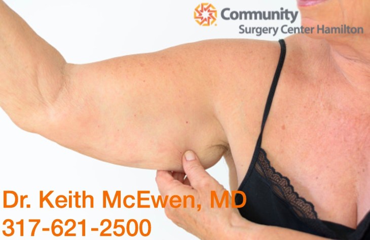 Dr. Keith McEwen MD Indianapolis Indiana Carmel Nobelsville Anderson Hamilton Community Surgery Center Hamilton Community Bariatrics Hamilton 46060 46011 46062 46033 46037 46074 46032 46220 46226 46055 46064 46030 46203 46239 46259 46163 46142 46143 lap-band system lap band system cost lap band system reviews lap band system patient education seminars lap band system access port lap band system pedometer lap band public system lap band ap system mri safety bioenterics lap band system lap-band ap system small lap band system lap-band system allergan lap band ap system large lap band gastric banding system franciscan health system lap band the new lap band system lap band through public system lap band surgery public system lap band system surgery the lap band system lap-band vg system what is lap band systemlap-band procedure lap-band removal lap-band system lap-band cost lap-band weight loss surgery lap-band complications lap-band diet lap-band® lap-band reviews lap-band alternative lap-band lap-band surgery lap-band adjustable gastric banding system lap band and pregnancy lap band australia lap band after gastric bypass lap band az lap band adjustment lap band and alcohol lap band and acid reflux lap band austin a lap band surgery a lap band removing a lap band can lapband be removed is a lap band permanent is a lap band safe is a lap band covered by insurance is a lap band reversible how a lap band works does a lap band work lap band before and after lap band before and after pictures lap band blog lap band before and after pics lap band brisbane lap band bmi lap band birmingham al lap band blockage lap band before and after stories lap band bariatric surgery b-2240 lap band lap band cost without insurance lap band covered by insurance lap band criteria lap band complications years later lap band canada lap band chicago lap band calgary lap band cons realize c lap band clap clap band clap clap bandcamp c section with lap band c-section and lap band surgery c section after lap band hepatitis c and lap band surgery lap band diet menu lap band diet plan lap band dallas lap band diet recipes lap band doctors lap band diet after surgery lap band dance lap band deaths lap band diet without surgery vitamin d deficiency lap band lap band erosion lap band edmonton lap band eligibility lap band erosion causes lap band eating plan lap band erosion lawsuit lap band experiences lap band eating rules lap band esophagus problems lap band erosion complications o que e lap band lap band forum lap band fill lap band failure lap band friendly recipes lap band forum australia lap band failure rate lap band food stuck lap band fill centers lap band failure stories lap band fort worth lap band gal lap band gone wrong lap band gas pain lap band gaining weight back lap band guidelines lap band gurgling noises lap band green zone lap band gallbladder issues lap band good or bad lap band gerd issues lap band houston lap band hypnosis lap band horror stories lap band heartburn and reflux lap band heartburn lap band hypnotherapy lap band houston cost lap band hobart lap band hair loss lap band hernia h pylori lap band lap band insurance lap band issues lap band in mexico lap band information lap band images lap band indiana lap band insurance requirements lap band infection lap band in houston lap band in mexico cost i lap band i want lap band surgery lap band jacksonville fl lap band journey lap band journey blog lap band jackson ms lap band joplin mo lap band joondalup lap band journal lap band jonesboro arkansas lap band jokes lap band juicing j&j lap band lap band kansas city lap band kaiser lap band knoxville tn lap band kelowna lap band killeen texas lap band katy tx lap band kidney stones lap band korea lap band kingsport tn lap band katy lap band lawsuit lap band las vegas lap band liquid diet lap band louisville ky lap band little rock ar lap band leak symptoms lap band lubbock lap band liquid diet recipes lap band long term complications lap band los angeles lap band mexico lap band meal plan lap band miami lap band mri safety lap band melbourne lap band meals lap band macon ga lap band medicare lap band memphis lap band mexico cost u of m lap band surgery lap band not working lap band not losing weight lap band night cough lap band nj lap band nz lap band nyc lap band no surgery lap band no weight loss lap band nausea lap band nutrition guidelines lite n easy lap band lap band or sleeve lap band okc lap band of louisville lap band ontario lap band orlando lap band operation lap band oklahoma lap band ontario cost lap band omaha lap band or sleeve which is better o sign lap band o'brien lap band placer cost of lap band surgery symptoms of lap band erosion removal of lap band dangers of lap band surgery symptoms of lap band slippage complications of lap band surgery complications of lap band cost of lap band removal lap band problems lap band pictures lap band pros and cons lap band pre op diet lap band port lap band price lap band port pain lap band post op diet lap band pregnancy s p lap band lap band qualifications lap band qualifications 2014 lap band qualifications 2015 lap band qualifications 2013 lap band questions lap band questions and answers lap band quiz lap band queensland lap band quick weight loss lap band qld q&a lap band lap band requirements lap band recipes lap band recovery lap band risks lap band results lap band removal recovery lap band removal surgery lap band removal complications lap-band surgery pros and cons lap band surgery cost lap band side effects lap band slippage lap band surgery reviews lap band surgery requirements lap band success stories lap band surgery risks s code for lap band adjustment what is lap band lap band talk lap band toronto lap band to sleeve revision lap band to gastric sleeve lap band testimonials lap band to gastric sleeve revision lap band tulsa lap band tucson lap band to gastric sleeve conversion lap band to sleeve conversion lap band t shirt lap band utah lap band uk lap band utah cost lap band unfill lap band united healthcare lap band ulcer lap band unfilled problems lap band ulcer issues lap band unsuccessful stories lap band upper gi youtube lap band youtube lap band surgery lap band u of m lap band vs sleeve lap band vomiting lap band video lap band vs bypass lap band vomiting after eating lap band vs sleeve 2013 lap band vomiting slime lap band vancouver lap band vs slimband lap band vomiting in sleep gastric bypass v lap band lap band v sleeve lap band weight loss lap band with plication lap band wiki lap band weight loss expectations lap band without surgery lap band weight loss results lap band weight requirements lap band weight loss first month lap band weight loss rate lap band w/plication lap band x ray gastric band x ray lap band slippage x ray slipped lap band x ray lap band position x ray gastric lap band x ray lap band angle x ray lap band surgery x ray x ray of lap band x ray of slipped lap band gas x after lap band lap band youtube lap band youtube video lap band youtube before and after lap band yahoo answers lap band yes or no lap band young adults lap band yuma az lap band years later lap band york pa lap band youtube 2012 lap band zones lap band zephyrhills florida gastric band zones lap band red zone lap band surgery zanesville ohio lap band new zealand lap band cost new zealand zoloft lap band lap band surgery christchurch new zealand gastric band zürich lap band 10 years later lap band 1st fill lap band 1 year later lap band 1 week post op lap band 101 lap band 1 month post-op lap band 18 years old lap band 16 year old lap band 14cc lap band 15 year old 1 800 lap band week 1 lap band diet lap band 2014 lap band 2013 lap band 2 week liquid diet lap band 2015 lap band 20 years old lap band 2 years post-op lap band 2 weeks post op lap band 2 months post op lap band 22 years old lap band 200 lbs week 2 lap band diet 2 year old lap band 2 dangers of lap band surgery 2 years after lap band 2 months after lap band 2 weeks after lap band lap band 2 years later day 2 after lap band lap band 30 pounds overweight lap band 3 weeks post op lap band 3 months post op lap band 3 years post op lap band 3 days post op lap band 35 bmi lap band 3 months later lap band 3 years later lap band 33 bmi lap band 31 bmi stage 3 lap band diet 3 lap joint band clamp week 3 lap band diet phase 3 lap band diet 3 months after lap band 3 days post lap band week 3 post lap band lap band 4 years later lap band 40 pounds overweight lap band 400 lbs lap band 4cc lap band after 4 years lap band for 40 lbs. overweight lap band week 4 allergan lap band 4cc lap band stage 4 diet lap band to lose 40 pounds stage 4 lap band diet 4 years after lap band 4 weeks after lap band lap band 5 years later lap band 5 day pouch test lap band 5 years post op lap band 50 lbs overweight lap band 5 cc fill lap band 5 months post op lap band 5 weeks post-op lap band $5000 lap band 50 pounds overweight lap band 5 day diet stage 5 lap band diet 5 years after lap band 5 days post op lap-band lap band 6 months post op lap band 60 pounds overweight lap band 6 years later lap band 6 cc fill lap band 6 weeks post op lap band 6 month diet lap band after 6 years lap band after 6 months lap band surgery over 60 lap band surgery over 65 6 months after lap band lap band 70 pounds overweight lap band after 7 years lap band surgery 77062 lap band 8 golden rules lap band after 8 years 800 lap band 8 golden rules lap band 8 rules of lap band lap band icd 9 lap band icd-9 code lap band erosion icd 9 lap band removal icd 9 lap band complication icd 9 lap band failure icd 9 slipped lap band icd-9 code 9.75 lap band infected lap band icd 9 icd 9 lap band complications icd 9 lap band icd 9 lap band surgery icd 9 lap band adjustment icd 9 gastric lap band icd 9 failed lap band icd 9 for lap band erosion bariatric banding surgery bariatric band surgery cost bariatric band diet bariatric band slippage bariatric band fills bariatric band complications bariatric band adjustment bariatric band manufacturers bariatric lap band bariatric lap band surgery problems bariatric band bariatric band surgery lap band bariatric surgery stomach band after pregnancy stomach band after c section stomach band as seen on tv stomach band after hysterectomy stomach band and cream to lose weight stomach band alternative stomach band at walmart stomach band and pregnancy stomach band after cesarean bariatric belly band stomach burner band stomach band before and after stomach band belt baby stomach band best stomach band after pregnancy best stomach band ballet stomach band lap band bariatric surgery before after bariatric surgery bypass vs band stomach band cost laparoscopic band complications stomach band covered by insurance stomach band cost canada stomach band canada stomach band cost sydney stomach band cost uk laparoscopic band cost stomach band candidate stomach band during pregnancy stomach band diabetes bariatric lap band diet bariatric surgery lap band diet stomach band exercise stomach band erosion stomach elastic band stomach earth band stomach elastic band surgery' stomach band to lose weight stomach band for working out stomach band for after pregnancy stomach band for pregnancy stomach band for exercise stomach band for acid reflux stomach band for running stomach band for abs stomach band for working out walmart stomach band hypnosis stomach band holster stomach band hypnotherapy stomach heat band stomach band infomercial stomach band in pakistan i-band bariatric surgery stomach band japanese stomach band japan stomach band lose weight stomach lift band lap band bariatric surgery cost lap band bariatric surgery forums lap band vs bariatric surgery bariatric lap band surgery diet bariatric lap band recipes stomach band mexico stomach band modells stomach muscle band stomach monkeys band stomach mouth band stomach band nz stomach band operation stomach band on nhs lap band or bariatric surgery stomach omaha band stomach band procedure stomach band post pregnancy stomach band pregnancy stomach band price stomach band problems laparoscopic band phi angle laparoscopic band placement laparoscopic band port stomach band perth laparoscopic band passer laparoscopic band removal stomach band reviews laparoscopic band radiographics stomach band removal laparoscopic band removal cpt code stomach band requirements stomach band risks stomach band recovery time laparoscopic band radiology laparoscopic band removal cpt bariatric surgery band slip stomach band surgery cost laparoscopic band surgery stomach band surgery risks stomach band surgery cost canada stomach band side effects laparoscopic band surgery cost stomach band to lose belly fat stomach band to lose weight cost stomach band that burns fat stomach band that makes you sweat stomach band to sweat stomach band to lose weight as seen on tv stomach band to workout stomach band toronto stomach band target stomach band uk stomach vibrating band lap band vs sleeve bariatric surgery bariatric sleeve vs band bariatric advantage vitaband stomach band walmart stomach band workout stomach band while working out stomach band wrap stomach band with gel stomach band while exercising stomach band wiki stomach band working out stomach band with lotion stomach band youtube lapbandindiana.com