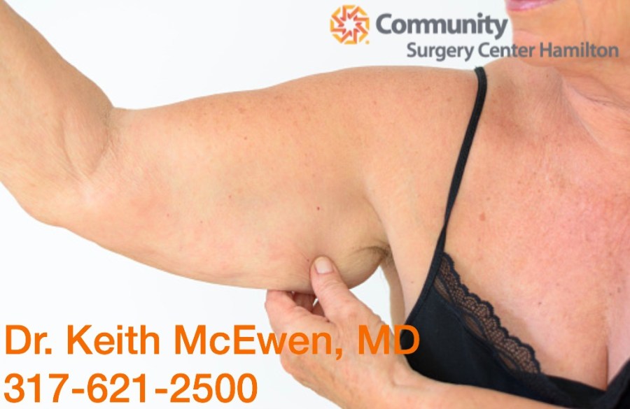 Will I Have Extra Skin After My Lap-Band&nbsp;Surgery?