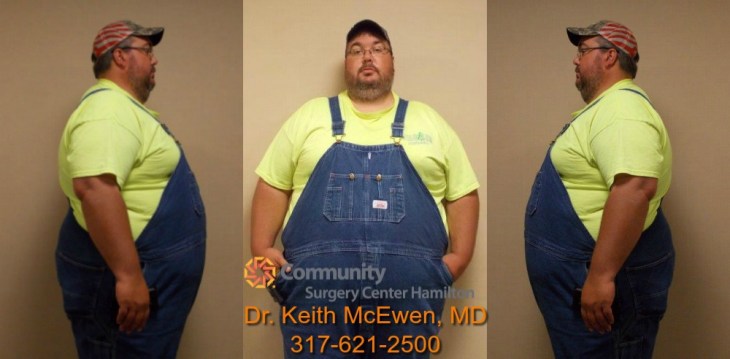 Dr. Keith McEwen MD Indianapolis Indiana Carmel Nobelsville Anderson Hamilton Community Surgery Center Hamilton Community Bariatrics Hamilton 46060 46011 46062 46033 46037 46074 46032 46220 46226 46055 46064 46030 46203 46239 46259 46163 46142 46143 lap-band system lap band system cost lap band system reviews lap band system patient education seminars lap band system access port lap band system pedometer lap band public system lap band ap system mri safety bioenterics lap band system lap-band ap system small lap band system lap-band system allergan lap band ap system large lap band gastric banding system franciscan health system lap band the new lap band system lap band through public system lap band surgery public system lap band system surgery the lap band system lap-band vg system what is lap band systemlap-band procedure lap-band removal lap-band system lap-band cost lap-band weight loss surgery lap-band complications lap-band diet lap-band® lap-band reviews lap-band alternative lap-band lap-band surgery lap-band adjustable gastric banding system lap band and pregnancy lap band australia lap band after gastric bypass lap band az lap band adjustment lap band and alcohol lap band and acid reflux lap band austin a lap band surgery a lap band removing a lap band can lapband be removed is a lap band permanent is a lap band safe is a lap band covered by insurance is a lap band reversible how a lap band works does a lap band work lap band before and after lap band before and after pictures lap band blog lap band before and after pics lap band brisbane lap band bmi lap band birmingham al lap band blockage lap band before and after stories lap band bariatric surgery b-2240 lap band lap band cost without insurance lap band covered by insurance lap band criteria lap band complications years later lap band canada lap band chicago lap band calgary lap band cons realize c lap band clap clap band clap clap bandcamp c section with lap band c-section and lap band surgery c section after lap band hepatitis c and lap band surgery lap band diet menu lap band diet plan lap band dallas lap band diet recipes lap band doctors lap band diet after surgery lap band dance lap band deaths lap band diet without surgery vitamin d deficiency lap band lap band erosion lap band edmonton lap band eligibility lap band erosion causes lap band eating plan lap band erosion lawsuit lap band experiences lap band eating rules lap band esophagus problems lap band erosion complications o que e lap band lap band forum lap band fill lap band failure lap band friendly recipes lap band forum australia lap band failure rate lap band food stuck lap band fill centers lap band failure stories lap band fort worth lap band gal lap band gone wrong lap band gas pain lap band gaining weight back lap band guidelines lap band gurgling noises lap band green zone lap band gallbladder issues lap band good or bad lap band gerd issues lap band houston lap band hypnosis lap band horror stories lap band heartburn and reflux lap band heartburn lap band hypnotherapy lap band houston cost lap band hobart lap band hair loss lap band hernia h pylori lap band lap band insurance lap band issues lap band in mexico lap band information lap band images lap band indiana lap band insurance requirements lap band infection lap band in houston lap band in mexico cost i lap band i want lap band surgery lap band jacksonville fl lap band journey lap band journey blog lap band jackson ms lap band joplin mo lap band joondalup lap band journal lap band jonesboro arkansas lap band jokes lap band juicing j&j lap band lap band kansas city lap band kaiser lap band knoxville tn lap band kelowna lap band killeen texas lap band katy tx lap band kidney stones lap band korea lap band kingsport tn lap band katy lap band lawsuit lap band las vegas lap band liquid diet lap band louisville ky lap band little rock ar lap band leak symptoms lap band lubbock lap band liquid diet recipes lap band long term complications lap band los angeles lap band mexico lap band meal plan lap band miami lap band mri safety lap band melbourne lap band meals lap band macon ga lap band medicare lap band memphis lap band mexico cost u of m lap band surgery lap band not working lap band not losing weight lap band night cough lap band nj lap band nz lap band nyc lap band no surgery lap band no weight loss lap band nausea lap band nutrition guidelines lite n easy lap band lap band or sleeve lap band okc lap band of louisville lap band ontario lap band orlando lap band operation lap band oklahoma lap band ontario cost lap band omaha lap band or sleeve which is better o sign lap band o'brien lap band placer cost of lap band surgery symptoms of lap band erosion removal of lap band dangers of lap band surgery symptoms of lap band slippage complications of lap band surgery complications of lap band cost of lap band removal lap band problems lap band pictures lap band pros and cons lap band pre op diet lap band port lap band price lap band port pain lap band post op diet lap band pregnancy s p lap band lap band qualifications lap band qualifications 2014 lap band qualifications 2015 lap band qualifications 2013 lap band questions lap band questions and answers lap band quiz lap band queensland lap band quick weight loss lap band qld q&a lap band lap band requirements lap band recipes lap band recovery lap band risks lap band results lap band removal recovery lap band removal surgery lap band removal complications lap-band surgery pros and cons lap band surgery cost lap band side effects lap band slippage lap band surgery reviews lap band surgery requirements lap band success stories lap band surgery risks s code for lap band adjustment what is lap band lap band talk lap band toronto lap band to sleeve revision lap band to gastric sleeve lap band testimonials lap band to gastric sleeve revision lap band tulsa lap band tucson lap band to gastric sleeve conversion lap band to sleeve conversion lap band t shirt lap band utah lap band uk lap band utah cost lap band unfill lap band united healthcare lap band ulcer lap band unfilled problems lap band ulcer issues lap band unsuccessful stories lap band upper gi youtube lap band youtube lap band surgery lap band u of m lap band vs sleeve lap band vomiting lap band video lap band vs bypass lap band vomiting after eating lap band vs sleeve 2013 lap band vomiting slime lap band vancouver lap band vs slimband lap band vomiting in sleep gastric bypass v lap band lap band v sleeve lap band weight loss lap band with plication lap band wiki lap band weight loss expectations lap band without surgery lap band weight loss results lap band weight requirements lap band weight loss first month lap band weight loss rate lap band w/plication lap band x ray gastric band x ray lap band slippage x ray slipped lap band x ray lap band position x ray gastric lap band x ray lap band angle x ray lap band surgery x ray x ray of lap band x ray of slipped lap band gas x after lap band lap band youtube lap band youtube video lap band youtube before and after lap band yahoo answers lap band yes or no lap band young adults lap band yuma az lap band years later lap band york pa lap band youtube 2012 lap band zones lap band zephyrhills florida gastric band zones lap band red zone lap band surgery zanesville ohio lap band new zealand lap band cost new zealand zoloft lap band lap band surgery christchurch new zealand gastric band zürich lap band 10 years later lap band 1st fill lap band 1 year later lap band 1 week post op lap band 101 lap band 1 month post-op lap band 18 years old lap band 16 year old lap band 14cc lap band 15 year old 1 800 lap band week 1 lap band diet lap band 2014 lap band 2013 lap band 2 week liquid diet lap band 2015 lap band 20 years old lap band 2 years post-op lap band 2 weeks post op lap band 2 months post op lap band 22 years old lap band 200 lbs week 2 lap band diet 2 year old lap band 2 dangers of lap band surgery 2 years after lap band 2 months after lap band 2 weeks after lap band lap band 2 years later day 2 after lap band lap band 30 pounds overweight lap band 3 weeks post op lap band 3 months post op lap band 3 years post op lap band 3 days post op lap band 35 bmi lap band 3 months later lap band 3 years later lap band 33 bmi lap band 31 bmi stage 3 lap band diet 3 lap joint band clamp week 3 lap band diet phase 3 lap band diet 3 months after lap band 3 days post lap band week 3 post lap band lap band 4 years later lap band 40 pounds overweight lap band 400 lbs lap band 4cc lap band after 4 years lap band for 40 lbs. overweight lap band week 4 allergan lap band 4cc lap band stage 4 diet lap band to lose 40 pounds stage 4 lap band diet 4 years after lap band 4 weeks after lap band lap band 5 years later lap band 5 day pouch test lap band 5 years post op lap band 50 lbs overweight lap band 5 cc fill lap band 5 months post op lap band 5 weeks post-op lap band $5000 lap band 50 pounds overweight lap band 5 day diet stage 5 lap band diet 5 years after lap band 5 days post op lap-band lap band 6 months post op lap band 60 pounds overweight lap band 6 years later lap band 6 cc fill lap band 6 weeks post op lap band 6 month diet lap band after 6 years lap band after 6 months lap band surgery over 60 lap band surgery over 65 6 months after lap band lap band 70 pounds overweight lap band after 7 years lap band surgery 77062 lap band 8 golden rules lap band after 8 years 800 lap band 8 golden rules lap band 8 rules of lap band lap band icd 9 lap band icd-9 code lap band erosion icd 9 lap band removal icd 9 lap band complication icd 9 lap band failure icd 9 slipped lap band icd-9 code 9.75 lap band infected lap band icd 9 icd 9 lap band complications icd 9 lap band icd 9 lap band surgery icd 9 lap band adjustment icd 9 gastric lap band icd 9 failed lap band icd 9 for lap band erosion bariatric banding surgery bariatric band surgery cost bariatric band diet bariatric band slippage bariatric band fills bariatric band complications bariatric band adjustment bariatric band manufacturers bariatric lap band bariatric lap band surgery problems bariatric band bariatric band surgery lap band bariatric surgery stomach band after pregnancy stomach band after c section stomach band as seen on tv stomach band after hysterectomy stomach band and cream to lose weight stomach band alternative stomach band at walmart stomach band and pregnancy stomach band after cesarean bariatric belly band stomach burner band stomach band before and after stomach band belt baby stomach band best stomach band after pregnancy best stomach band ballet stomach band lap band bariatric surgery before after bariatric surgery bypass vs band stomach band cost laparoscopic band complications stomach band covered by insurance stomach band cost canada stomach band canada stomach band cost sydney stomach band cost uk laparoscopic band cost stomach band candidate stomach band during pregnancy stomach band diabetes bariatric lap band diet bariatric surgery lap band diet stomach band exercise stomach band erosion stomach elastic band stomach earth band stomach elastic band surgery' stomach band to lose weight stomach band for working out stomach band for after pregnancy stomach band for pregnancy stomach band for exercise stomach band for acid reflux stomach band for running stomach band for abs stomach band for working out walmart stomach band hypnosis stomach band holster stomach band hypnotherapy stomach heat band stomach band infomercial stomach band in pakistan i-band bariatric surgery stomach band japanese stomach band japan stomach band lose weight stomach lift band lap band bariatric surgery cost lap band bariatric surgery forums lap band vs bariatric surgery bariatric lap band surgery diet bariatric lap band recipes stomach band mexico stomach band modells stomach muscle band stomach monkeys band stomach mouth band stomach band nz stomach band operation stomach band on nhs lap band or bariatric surgery stomach omaha band stomach band procedure stomach band post pregnancy stomach band pregnancy stomach band price stomach band problems laparoscopic band phi angle laparoscopic band placement laparoscopic band port stomach band perth laparoscopic band passer laparoscopic band removal stomach band reviews laparoscopic band radiographics stomach band removal laparoscopic band removal cpt code stomach band requirements stomach band risks stomach band recovery time laparoscopic band radiology laparoscopic band removal cpt bariatric surgery band slip stomach band surgery cost laparoscopic band surgery stomach band surgery risks stomach band surgery cost canada stomach band side effects laparoscopic band surgery cost stomach band to lose belly fat stomach band to lose weight cost stomach band that burns fat stomach band that makes you sweat stomach band to sweat stomach band to lose weight as seen on tv stomach band to workout stomach band toronto stomach band target stomach band uk stomach vibrating band lap band vs sleeve bariatric surgery bariatric sleeve vs band bariatric advantage vitaband stomach band walmart stomach band workout stomach band while working out stomach band wrap stomach band with gel stomach band while exercising stomach band wiki stomach band working out stomach band with lotion stomach band youtube lapbandindiana.com