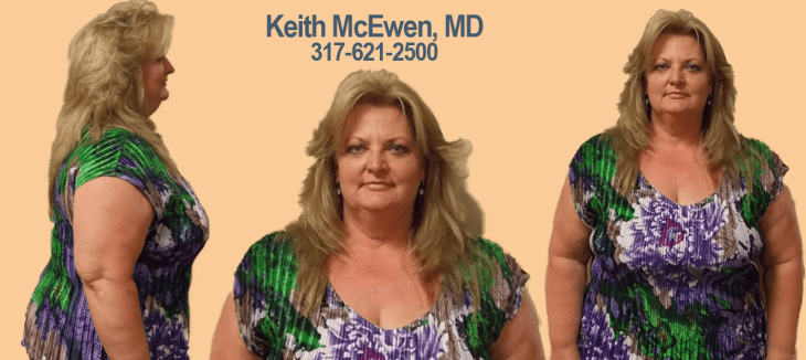 One of ours biggest rewards is witnessing the emotional changes our patients go through during their LAP-BAND journey. Meet Gwen. She came to us with a story many can relate to: low self-esteem and with no other desirable weight loss options. Since starting her journey in 2013, Gwen has lost a total of 82 pounds. She has blossom into the person she always knew she was and can happily share her a piece of her journey and some advice. What has been your biggest change since lap band surgery? The biggest change in my life has been my self confidence. I used to be very self conscious about my weight, and hated buying new clothes. Especially when I had to go up a size. Starting at a size 26, before my lap band. I am now a size 10. Which is smaller then my senior year of high school! I can now hold my head up proudly any where I go, and I don't have to find clothes to hide behind. I love the new me. And it shows in how I carry my self confidence. I knew this thin person existed on the inside. Now I can actually see it on the outside. What has been your biggest non-scale victory? (less medications, not needing a seat-belt extender on planes, more energy, etc.) My biggest non-scale victory is I have more energy! I love to go shopping now. I feel so much more comfortable in my own skin.  What advice would you give someone thinking about lap band surgery Contrary to popular belief, this is still hard work. It (the lap band) is not a magic pill. You need to embrace the changes and put in the time and effort to your diet and lifestyle changes for this to work. Want to feel comfortable in your own skin like Gwen? Learn more about our LAP-BAND system by attending our FREE info seminar on June 14th, led by Doctor McEwen or give us a call at 317-621-2500.