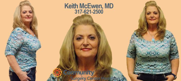 One of ours biggest rewards is witnessing the emotional changes our patients go through during their LAP-BAND journey. Meet Gwen. She came to us with a story many can relate to: low self-esteem and with no other desirable weight loss options. Since starting her journey in 2013, Gwen has lost a total of 82 pounds. She has blossom into the person she always knew she was and can happily share her a piece of her journey and some advice. What has been your biggest change since lap band surgery? The biggest change in my life has been my self confidence. I used to be very self conscious about my weight, and hated buying new clothes. Especially when I had to go up a size. Starting at a size 26, before my lap band. I am now a size 10. Which is smaller then my senior year of high school! I can now hold my head up proudly any where I go, and I don't have to find clothes to hide behind. I love the new me. And it shows in how I carry my self confidence. I knew this thin person existed on the inside. Now I can actually see it on the outside. What has been your biggest non-scale victory? (less medications, not needing a seat-belt extender on planes, more energy, etc.) My biggest non-scale victory is I have more energy! I love to go shopping now. I feel so much more comfortable in my own skin.  What advice would you give someone thinking about lap band surgery Contrary to popular belief, this is still hard work. It (the lap band) is not a magic pill. You need to embrace the changes and put in the time and effort to your diet and lifestyle changes for this to work. Want to feel comfortable in your own skin like Gwen? Learn more about our LAP-BAND system by attending our FREE info seminar on June 14th, led by Doctor McEwen or give us a call at 317-621-2500.