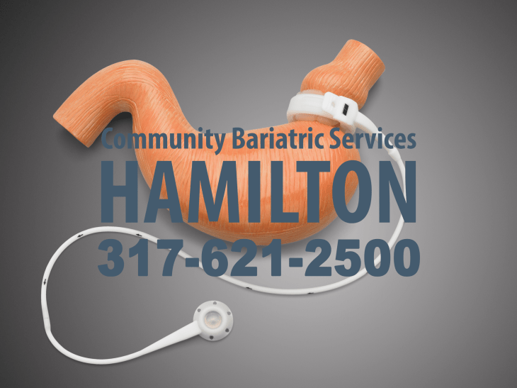 acid reflux after lap band adjustment adjustment of lap band adjustment of lap band cpt billing for lap band adjustment cost of lap band adjustment cpt for lap band adjustment diagnosis code for lap band adjustment does lap band adjustment hurt eating after a lap band adjustment eating after lap band adjustment emergency lap band adjustment frequency of lap band adjustment gastric band adjustment aberdeen gastric band adjustment at home gastric band adjustment birmingham gastric band adjustment brighton gastric band adjustment clinic liverpool gastric band adjustment clinics london gastric band adjustment credentialing guidelines for physician extenders gastric band adjustment diet gastric band adjustment dubai gastric band adjustment edinburgh gastric band adjustment essex gastric band adjustment glasgow gastric band adjustment harrow gastric band adjustment ireland gastric band adjustment kent gastric band adjustment leeds gastric band adjustment liverpool gastric band adjustment london gastric band adjustment manchester gastric band adjustment newcastle gastric band adjustment norwich gastric band adjustment nottingham gastric band adjustment prices gastric band adjustment procedure gastric band adjustment protocol gastric band adjustment training gastric band adjustment uk gastric band adjustment video gastric band adjustment yorkshire gastric band adjustments in u.k gastric band port adjustment how are lap band adjustments done icd 9 lap band adjustment icd-9 code for lap band adjustment lap band adjustment lap band adjustment after pregnancy lap band adjustment billing lap band adjustment cairns lap band adjustment centers lap band adjustment chest pain lap band adjustment code lap band adjustment complications lap band adjustment cost lap band adjustment cost uk lap band adjustment cpt code lap band adjustment cpt code 2013 lap band adjustment cpt code medicare lap band adjustment dictation lap band adjustment diet lap band adjustment doctors lap band adjustment during pregnancy lap band adjustment fluoroscopy lap band adjustment frequency lap band adjustment gold coast lap band adjustment houston lap band adjustment how often lap band adjustment icd 9 code lap band adjustment instructions lap band adjustment liquid diet lap band adjustment london lap band adjustment mackay lap band adjustment medicare lap band adjustment melbourne lap band adjustment near me lap band adjustment needle lap band adjustment nj lap band adjustment orlando lap band adjustment pain lap band adjustment perth lap band adjustment phoenix lap band adjustment procedure lap band adjustment procedure code lap band adjustment reimbursement lap band adjustment side effects lap band adjustment training lap band adjustment under fluoroscopy lap band adjustment under fluoroscopy cpt code lap band adjustment video lap band adjustment vomiting lap band adjustment while pregnant lap band adjustments lap band adjustments brisbane lap band adjustments cairns lap band adjustments gold coast lap band adjustments houston tx lap band adjustments how often lap band adjustments in miami lap band adjustments las vegas lap band adjustments melbourne lap band adjustments near me lap band diet after adjustment lap band fill adjustment lap band first adjustment lap band post adjustment diet liquid diet after lap band adjustment needle used for lap band adjustment pain after lap band adjustment s code for lap band adjustment still hungry after lap band adjustment vomiting after lap band adjustment weight gain after lap band adjustment what is a lap band adjustment what is lap band adjustment