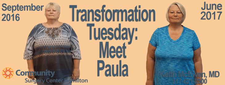 Paula TT 1 Transformation Tuesday Weight Loss Surgery Dr. Keith McEwen Lab-Band Hamilton Indianapolis Indiana obesity center 317-621-2500 labpandindiana