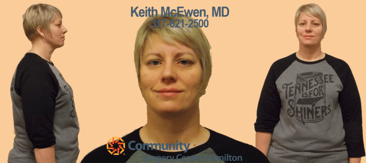 Mary TT 3 Transformation Tuesday Weight Loss Surgery Dr. Keith McEwen Lab-Band Hamilton Indianapolis Indiana obesity center 317-621-2500 labpandindiana
