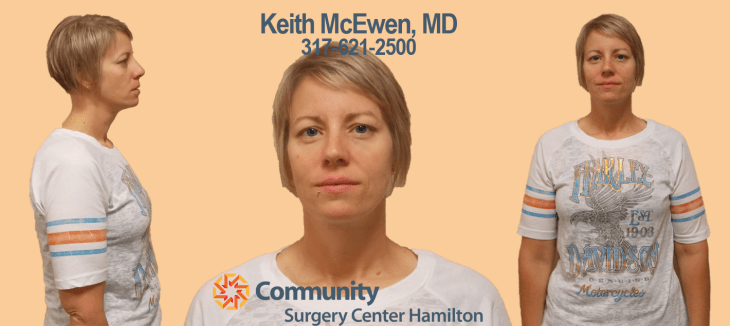 Dr. Keith McEwen MD Indianapolis Indiana Carmel Nobelsville Anderson Hamilton Community Surgery Center Hamilton Community Bariatrics Hamilton 46060 46011 46062 46033 46037 46074 46032 46220 46226 46055 46064 46030 46203 46239 46259 46163 46142 46143 lap-band system lap band system cost lap band system reviews lap band system patient education seminars lap band system access port lap band system pedometer lap band public system lap band ap system mri safety bioenterics lap band system lap-band ap system small lap band system lap-band system allergan lap band ap system large lap band gastric banding system franciscan health system lap band the new lap band system lap band through public system lap band surgery public system lap band system surgery the lap band system lap-band vg system what is lap band systemlap-band procedure lap-band removal lap-band system lap-band cost lap-band weight loss surgery lap-band complications lap-band diet lap-band® lap-band reviews lap-band alternative lap-band lap-band surgery lap-band adjustable gastric banding system lap band and pregnancy lap band australia lap band after gastric bypass lap band az lap band adjustment lap band and alcohol lap band and acid reflux lap band austin a lap band surgery a lap band removing a lap band can lapband be removed is a lap band permanent is a lap band safe is a lap band covered by insurance is a lap band reversible how a lap band works does a lap band work lap band before and after lap band before and after pictures lap band blog lap band before and after pics lap band brisbane lap band bmi lap band birmingham al lap band blockage lap band before and after stories lap band bariatric surgery b-2240 lap band lap band cost without insurance lap band covered by insurance lap band criteria lap band complications years later lap band canada lap band chicago lap band calgary lap band cons realize c lap band clap clap band clap clap bandcamp c section with lap band c-section and lap band surgery c section after lap band hepatitis c and lap band surgery lap band diet menu lap band diet plan lap band dallas lap band diet recipes lap band doctors lap band diet after surgery lap band dance lap band deaths lap band diet without surgery vitamin d deficiency lap band lap band erosion lap band edmonton lap band eligibility lap band erosion causes lap band eating plan lap band erosion lawsuit lap band experiences lap band eating rules lap band esophagus problems lap band erosion complications o que e lap band lap band forum lap band fill lap band failure lap band friendly recipes lap band forum australia lap band failure rate lap band food stuck lap band fill centers lap band failure stories lap band fort worth lap band gal lap band gone wrong lap band gas pain lap band gaining weight back lap band guidelines lap band gurgling noises lap band green zone lap band gallbladder issues lap band good or bad lap band gerd issues lap band houston lap band hypnosis lap band horror stories lap band heartburn and reflux lap band heartburn lap band hypnotherapy lap band houston cost lap band hobart lap band hair loss lap band hernia h pylori lap band lap band insurance lap band issues lap band in mexico lap band information lap band images lap band indiana lap band insurance requirements lap band infection lap band in houston lap band in mexico cost i lap band i want lap band surgery lap band jacksonville fl lap band journey lap band journey blog lap band jackson ms lap band joplin mo lap band joondalup lap band journal lap band jonesboro arkansas lap band jokes lap band juicing j&j lap band lap band kansas city lap band kaiser lap band knoxville tn lap band kelowna lap band killeen texas lap band katy tx lap band kidney stones lap band korea lap band kingsport tn lap band katy lap band lawsuit lap band las vegas lap band liquid diet lap band louisville ky lap band little rock ar lap band leak symptoms lap band lubbock lap band liquid diet recipes lap band long term complications lap band los angeles lap band mexico lap band meal plan lap band miami lap band mri safety lap band melbourne lap band meals lap band macon ga lap band medicare lap band memphis lap band mexico cost u of m lap band surgery lap band not working lap band not losing weight lap band night cough lap band nj lap band nz lap band nyc lap band no surgery lap band no weight loss lap band nausea lap band nutrition guidelines lite n easy lap band lap band or sleeve lap band okc lap band of louisville lap band ontario lap band orlando lap band operation lap band oklahoma lap band ontario cost lap band omaha lap band or sleeve which is better o sign lap band o'brien lap band placer cost of lap band surgery symptoms of lap band erosion removal of lap band dangers of lap band surgery symptoms of lap band slippage complications of lap band surgery complications of lap band cost of lap band removal lap band problems lap band pictures lap band pros and cons lap band pre op diet lap band port lap band price lap band port pain lap band post op diet lap band pregnancy s p lap band lap band qualifications lap band qualifications 2014 lap band qualifications 2015 lap band qualifications 2013 lap band questions lap band questions and answers lap band quiz lap band queensland lap band quick weight loss lap band qld q&a lap band lap band requirements lap band recipes lap band recovery lap band risks lap band results lap band removal recovery lap band removal surgery lap band removal complications lap-band surgery pros and cons lap band surgery cost lap band side effects lap band slippage lap band surgery reviews lap band surgery requirements lap band success stories lap band surgery risks s code for lap band adjustment what is lap band lap band talk lap band toronto lap band to sleeve revision lap band to gastric sleeve lap band testimonials lap band to gastric sleeve revision lap band tulsa lap band tucson lap band to gastric sleeve conversion lap band to sleeve conversion lap band t shirt lap band utah lap band uk lap band utah cost lap band unfill lap band united healthcare lap band ulcer lap band unfilled problems lap band ulcer issues lap band unsuccessful stories lap band upper gi youtube lap band youtube lap band surgery lap band u of m lap band vs sleeve lap band vomiting lap band video lap band vs bypass lap band vomiting after eating lap band vs sleeve 2013 lap band vomiting slime lap band vancouver lap band vs slimband lap band vomiting in sleep gastric bypass v lap band lap band v sleeve lap band weight loss lap band with plication lap band wiki lap band weight loss expectations lap band without surgery lap band weight loss results lap band weight requirements lap band weight loss first month lap band weight loss rate lap band w/plication lap band x ray gastric band x ray lap band slippage x ray slipped lap band x ray lap band position x ray gastric lap band x ray lap band angle x ray lap band surgery x ray x ray of lap band x ray of slipped lap band gas x after lap band lap band youtube lap band youtube video lap band youtube before and after lap band yahoo answers lap band yes or no lap band young adults lap band yuma az lap band years later lap band york pa lap band youtube 2012 lap band zones lap band zephyrhills florida gastric band zones lap band red zone lap band surgery zanesville ohio lap band new zealand lap band cost new zealand zoloft lap band lap band surgery christchurch new zealand gastric band zürich lap band 10 years later lap band 1st fill lap band 1 year later lap band 1 week post op lap band 101 lap band 1 month post-op lap band 18 years old lap band 16 year old lap band 14cc lap band 15 year old 1 800 lap band week 1 lap band diet lap band 2014 lap band 2013 lap band 2 week liquid diet lap band 2015 lap band 20 years old lap band 2 years post-op lap band 2 weeks post op lap band 2 months post op lap band 22 years old lap band 200 lbs week 2 lap band diet 2 year old lap band 2 dangers of lap band surgery 2 years after lap band 2 months after lap band 2 weeks after lap band lap band 2 years later day 2 after lap band lap band 30 pounds overweight lap band 3 weeks post op lap band 3 months post op lap band 3 years post op lap band 3 days post op lap band 35 bmi lap band 3 months later lap band 3 years later lap band 33 bmi lap band 31 bmi stage 3 lap band diet 3 lap joint band clamp week 3 lap band diet phase 3 lap band diet 3 months after lap band 3 days post lap band week 3 post lap band lap band 4 years later lap band 40 pounds overweight lap band 400 lbs lap band 4cc lap band after 4 years lap band for 40 lbs. overweight lap band week 4 allergan lap band 4cc lap band stage 4 diet lap band to lose 40 pounds stage 4 lap band diet 4 years after lap band 4 weeks after lap band lap band 5 years later lap band 5 day pouch test lap band 5 years post op lap band 50 lbs overweight lap band 5 cc fill lap band 5 months post op lap band 5 weeks post-op lap band $5000 lap band 50 pounds overweight lap band 5 day diet stage 5 lap band diet 5 years after lap band 5 days post op lap-band lap band 6 months post op lap band 60 pounds overweight lap band 6 years later lap band 6 cc fill lap band 6 weeks post op lap band 6 month diet lap band after 6 years lap band after 6 months lap band surgery over 60 lap band surgery over 65 6 months after lap band lap band 70 pounds overweight lap band after 7 years lap band surgery 77062 lap band 8 golden rules lap band after 8 years 800 lap band 8 golden rules lap band 8 rules of lap band lap band icd 9 lap band icd-9 code lap band erosion icd 9 lap band removal icd 9 lap band complication icd 9 lap band failure icd 9 slipped lap band icd-9 code 9.75 lap band infected lap band icd 9 icd 9 lap band complications icd 9 lap band icd 9 lap band surgery icd 9 lap band adjustment icd 9 gastric lap band icd 9 failed lap band icd 9 for lap band erosion bariatric banding surgery bariatric band surgery cost bariatric band diet bariatric band slippage bariatric band fills bariatric band complications bariatric band adjustment bariatric band manufacturers bariatric lap band bariatric lap band surgery problems bariatric band bariatric band surgery lap band bariatric surgery stomach band after pregnancy stomach band after c section stomach band as seen on tv stomach band after hysterectomy stomach band and cream to lose weight stomach band alternative stomach band at walmart stomach band and pregnancy stomach band after cesarean bariatric belly band stomach burner band stomach band before and after stomach band belt baby stomach band best stomach band after pregnancy best stomach band ballet stomach band lap band bariatric surgery before after bariatric surgery bypass vs band stomach band cost laparoscopic band complications stomach band covered by insurance stomach band cost canada stomach band canada stomach band cost sydney stomach band cost uk laparoscopic band cost stomach band candidate stomach band during pregnancy stomach band diabetes bariatric lap band diet bariatric surgery lap band diet stomach band exercise stomach band erosion stomach elastic band stomach earth band stomach elastic band surgery' stomach band to lose weight stomach band for working out stomach band for after pregnancy stomach band for pregnancy stomach band for exercise stomach band for acid reflux stomach band for running stomach band for abs stomach band for working out walmart stomach band hypnosis stomach band holster stomach band hypnotherapy stomach heat band stomach band infomercial stomach band in pakistan i-band bariatric surgery stomach band japanese stomach band japan stomach band lose weight stomach lift band lap band bariatric surgery cost lap band bariatric surgery forums lap band vs bariatric surgery bariatric lap band surgery diet bariatric lap band recipes stomach band mexico stomach band modells stomach muscle band stomach monkeys band stomach mouth band stomach band nz stomach band operation stomach band on nhs lap band or bariatric surgery stomach omaha band stomach band procedure stomach band post pregnancy stomach band pregnancy stomach band price stomach band problems laparoscopic band phi angle laparoscopic band placement laparoscopic band port stomach band perth laparoscopic band passer laparoscopic band removal stomach band reviews laparoscopic band radiographics stomach band removal laparoscopic band removal cpt code stomach band requirements stomach band risks stomach band recovery time laparoscopic band radiology laparoscopic band removal cpt bariatric surgery band slip stomach band surgery cost laparoscopic band surgery stomach band surgery risks stomach band surgery cost canada stomach band side effects laparoscopic band surgery cost stomach band to lose belly fat stomach band to lose weight cost stomach band that burns fat stomach band that makes you sweat stomach band to sweat stomach band to lose weight as seen on tv stomach band to workout stomach band toronto stomach band target stomach band uk stomach vibrating band lap band vs sleeve bariatric surgery bariatric sleeve vs band bariatric advantage vitaband stomach band walmart stomach band workout stomach band while working out stomach band wrap stomach band with gel stomach band while exercising stomach band wiki stomach band working out stomach band with lotion stomach band youtube lapbandindiana.com