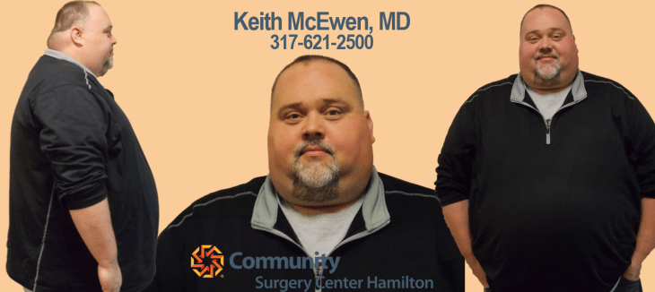 Rich TT Before Transformation Tuesday Weight Loss Surgery Dr. Keith McEwen Lab-Band Hamilton Indianapolis Indiana obesity center 317-621-2500 labpandindiana